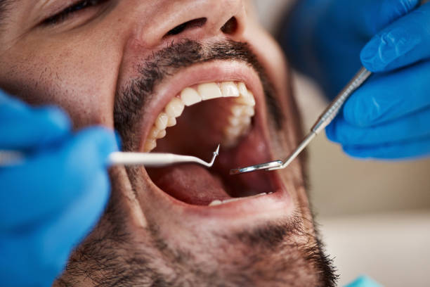 Best Wisdom Tooth Removal  in Lubeck, WV